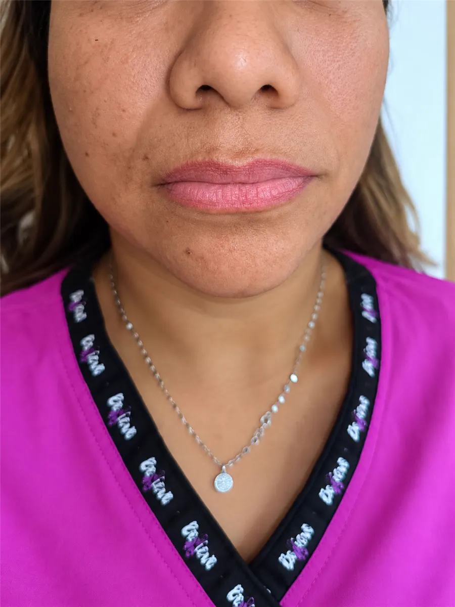Caso real 4: labios antes de la correccion